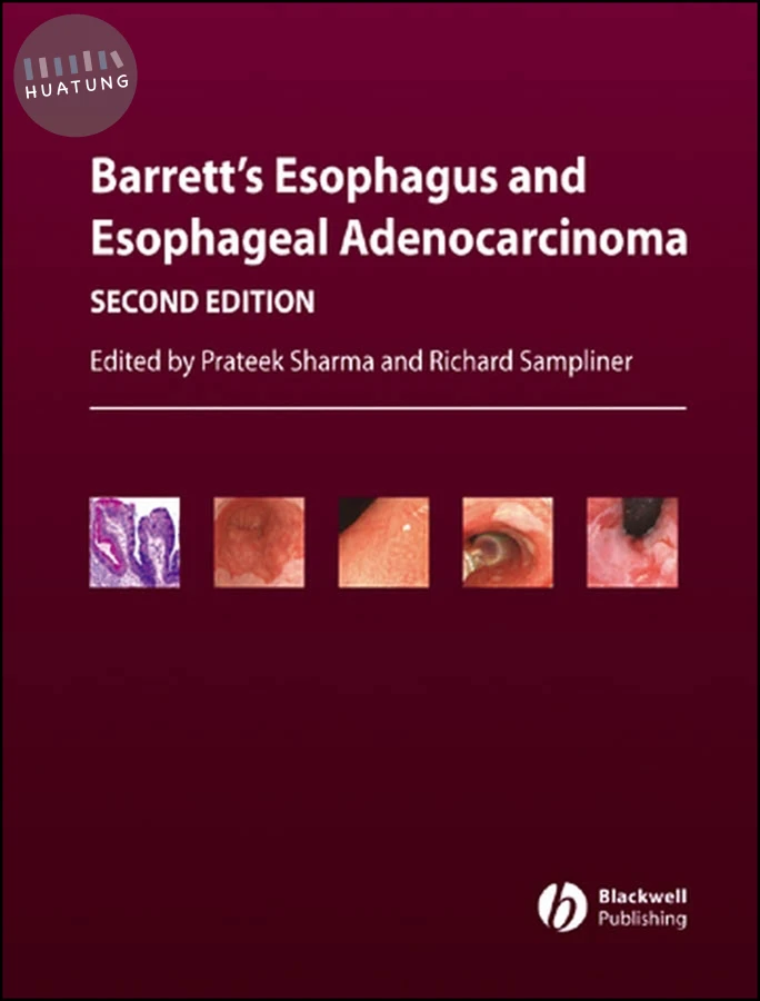 Barrett's Esophagus and Esophageal Adenocarcinoma 