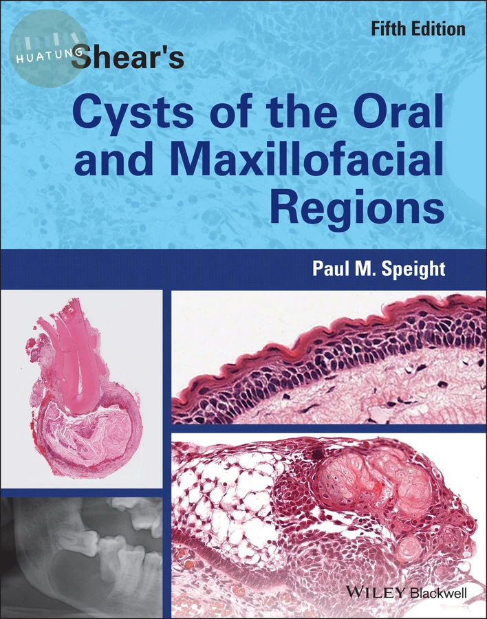 Shear's Cysts of the Oral and Maxillofacial Regions 