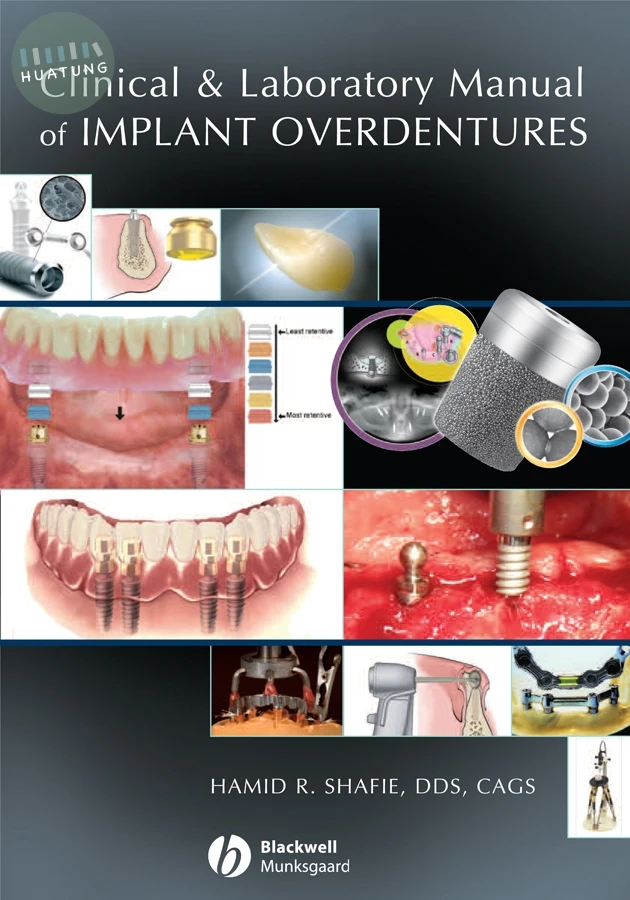Clinical and Laboratory Manual of Implant Overdentures 