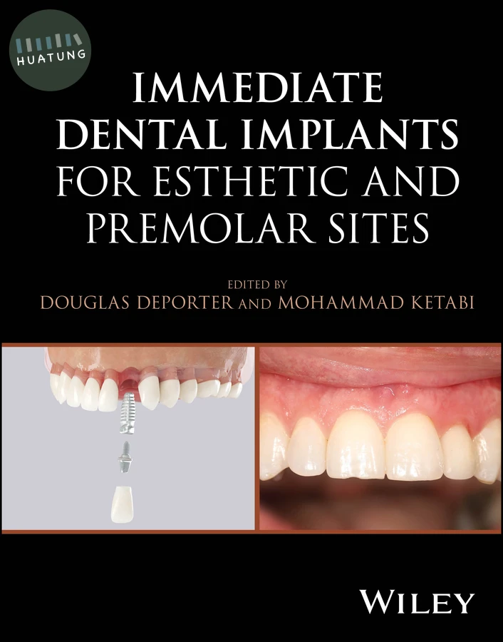 Immediate Dental Implants for Esthetic and Premolar Sites 