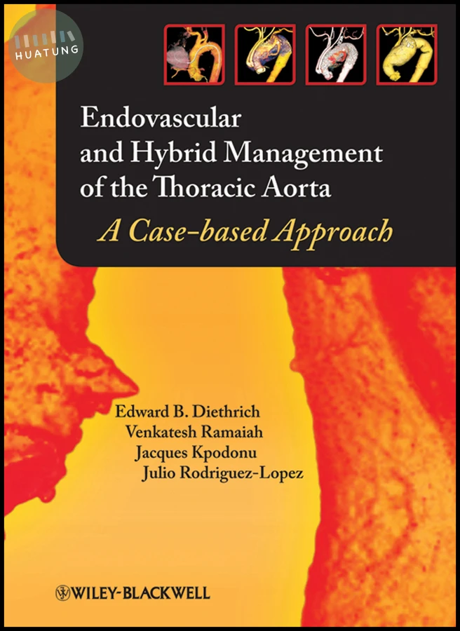 Endovascular and Hybrid Management of the Thoracic Aorta 