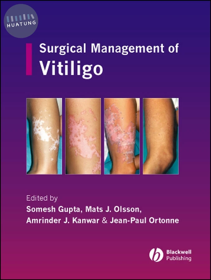 Surgical Management of Vitiligo 